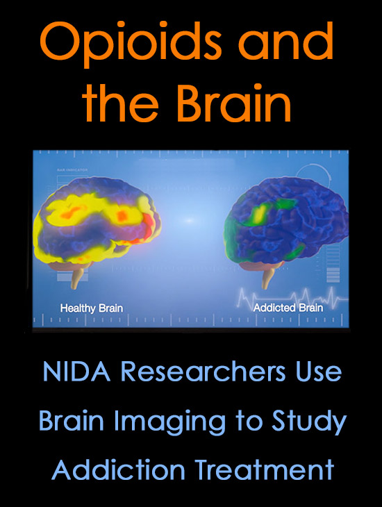 Opioid Addiction Brain Imaging Research