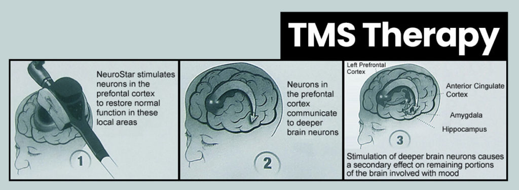 TMS Therapy Transcranial Magnetic Stimulation Therapy