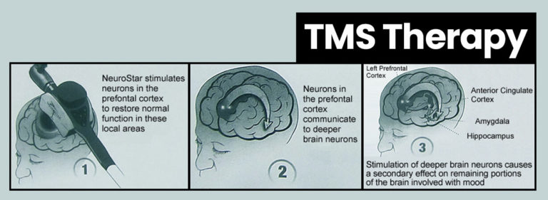 Transcranial Magnetic Stimulation Therapy Tms Therapy Inspire Malibu