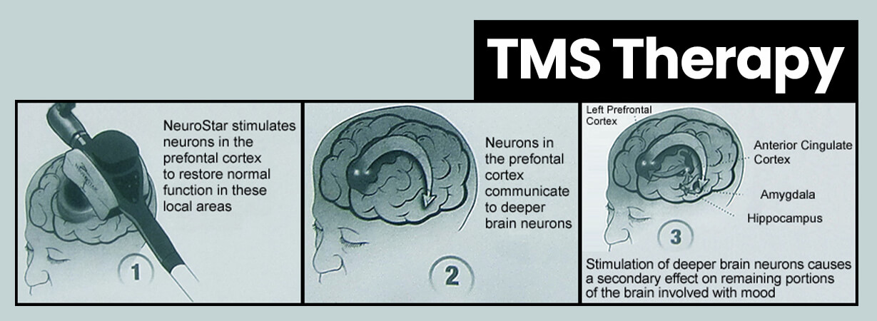 Transcranial Magnetic Stimulation Therapy (TMS Therapy) | Inspire Malibu